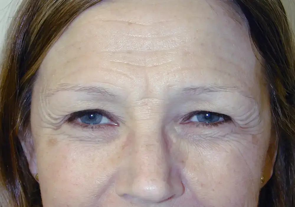 Brow-Lift--3727 | Before Brow Lift 2