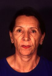 California-Facelift--6830 | Before California Facelift