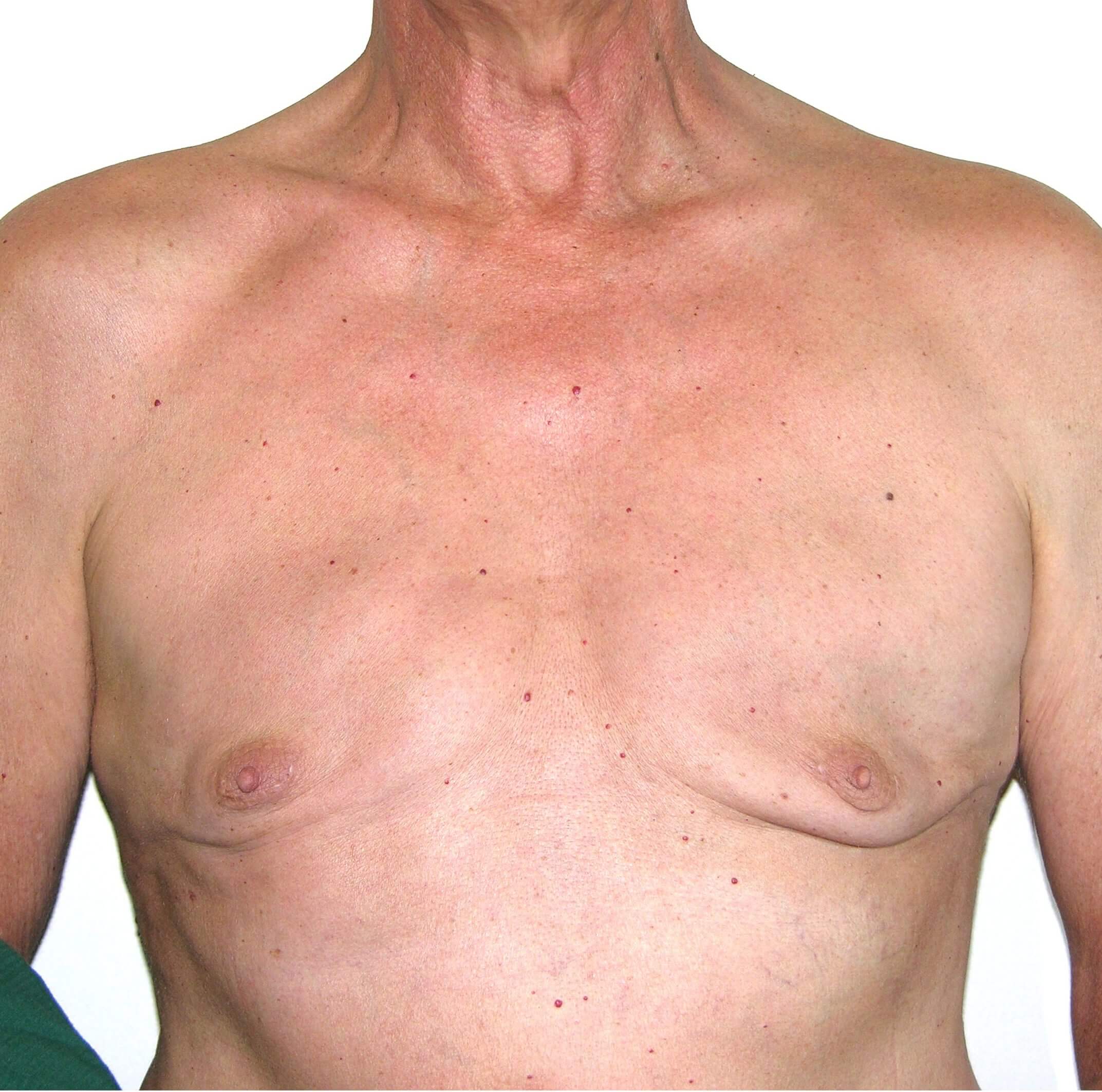 Gynecomastia--7506 | After Gynecomastia