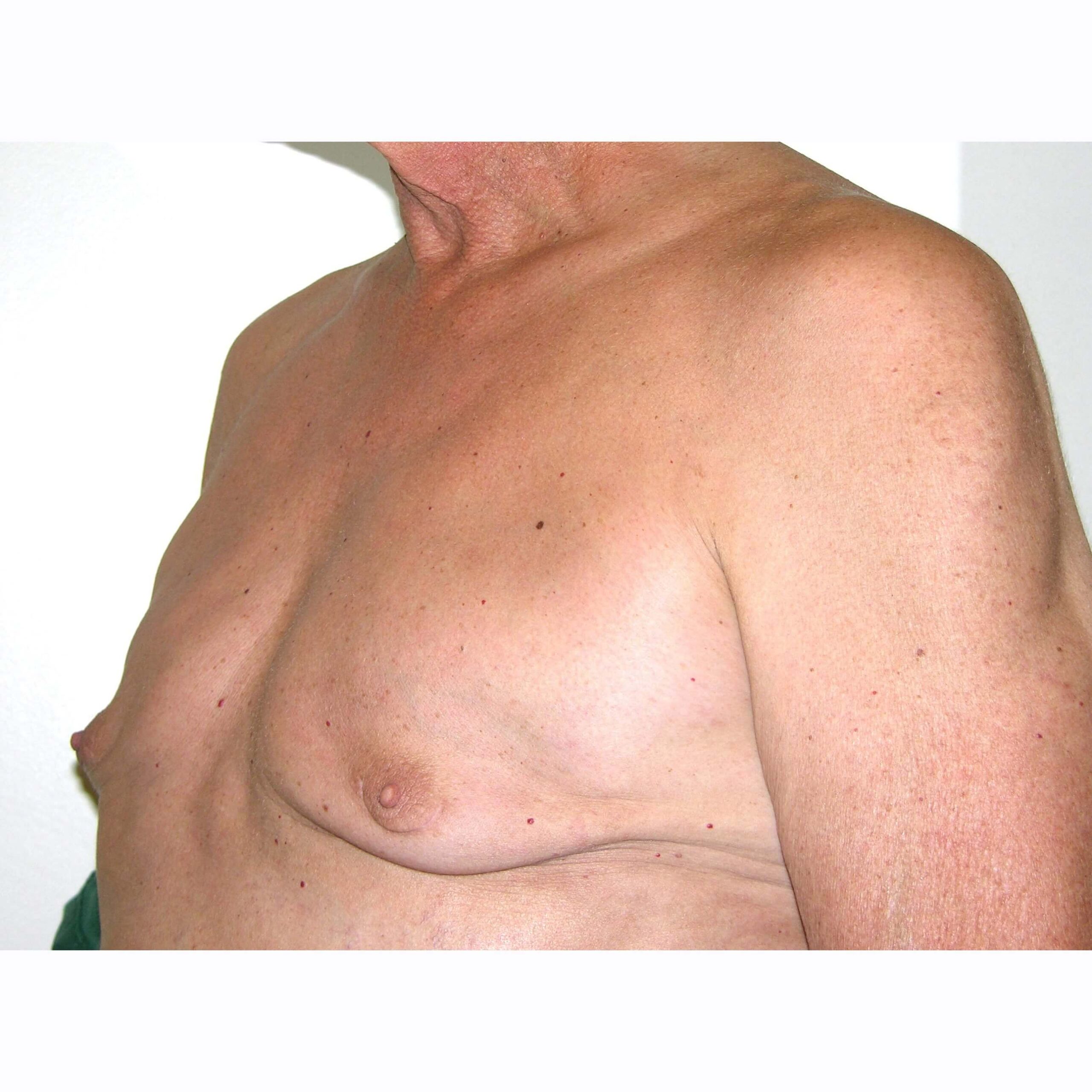 Gynecomastia--7506 | After Gynecomastia 2