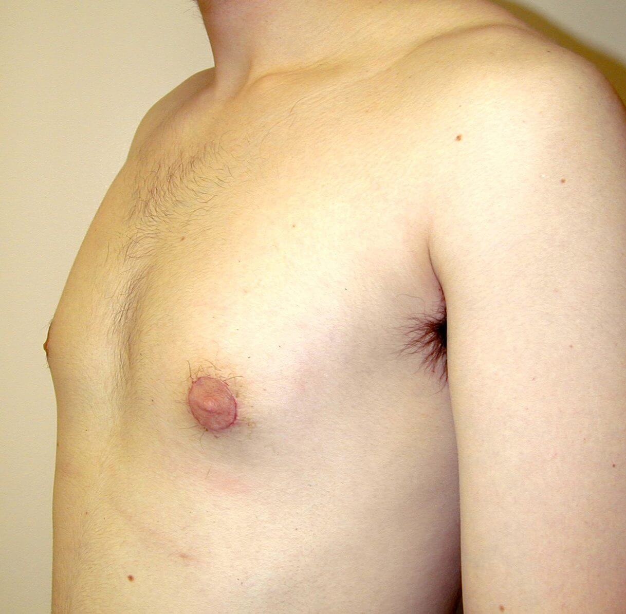 Gynecomastia--8536 | After Gynecomastia 2