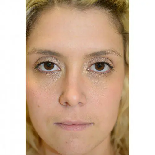 Case--8324 | Before Peels & Fillers