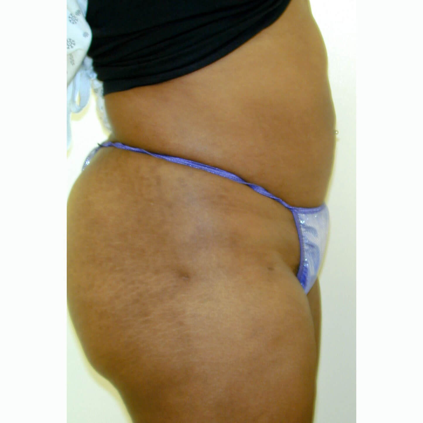 Liposuction--2333 | After Liposuction 3