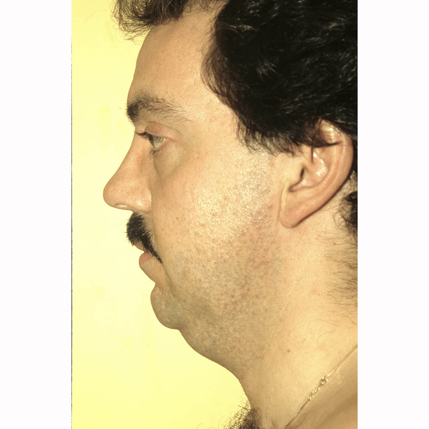 Liposuction--9931 | Before Body