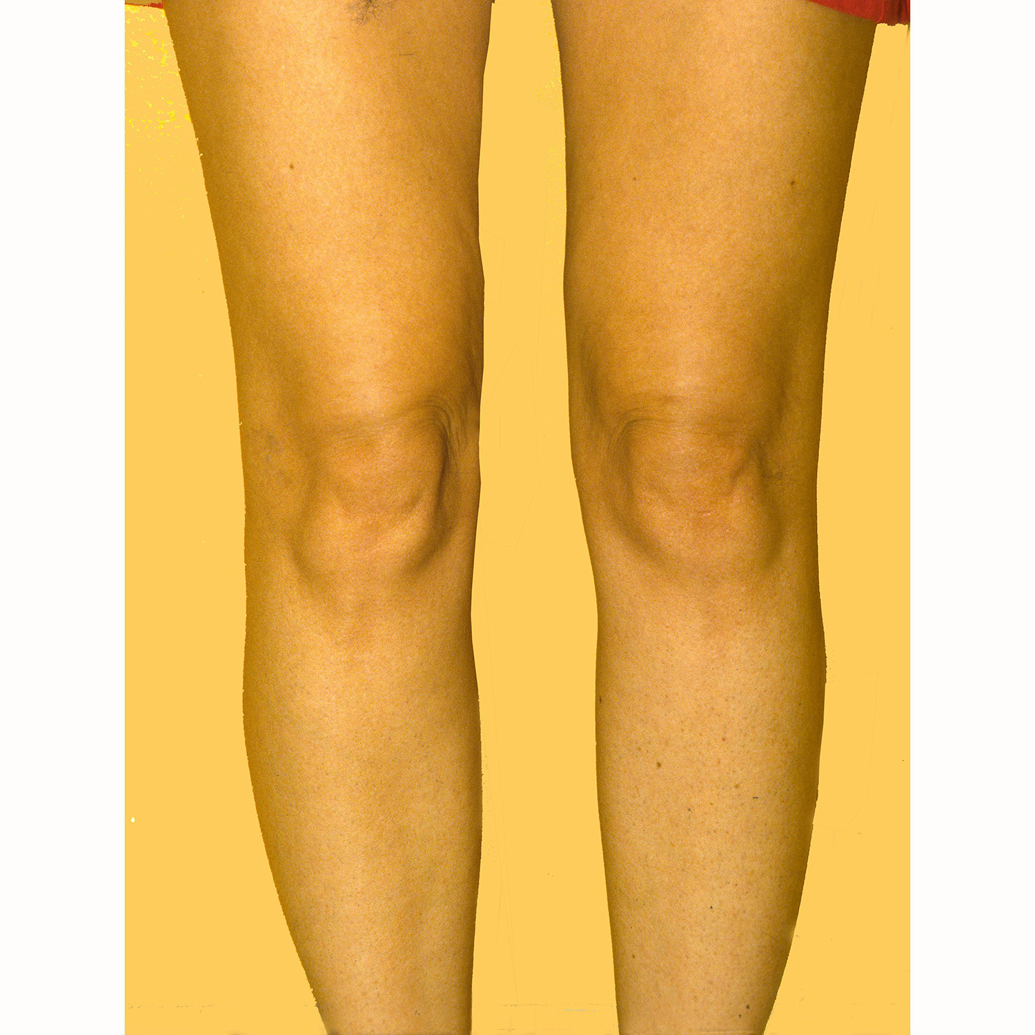 Liposuction--3486 | After Body