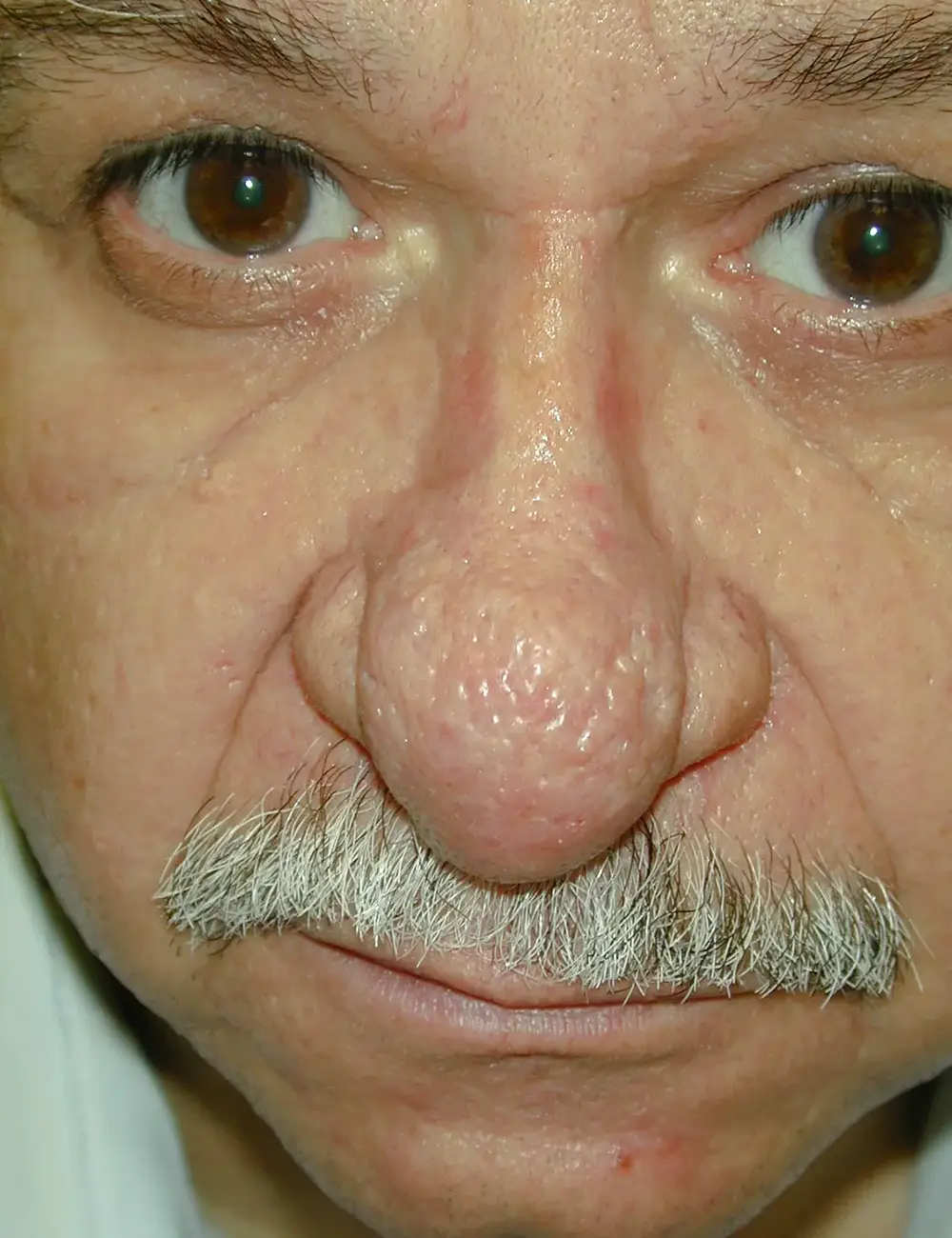 Rhinoplasty 3894 Before Front View