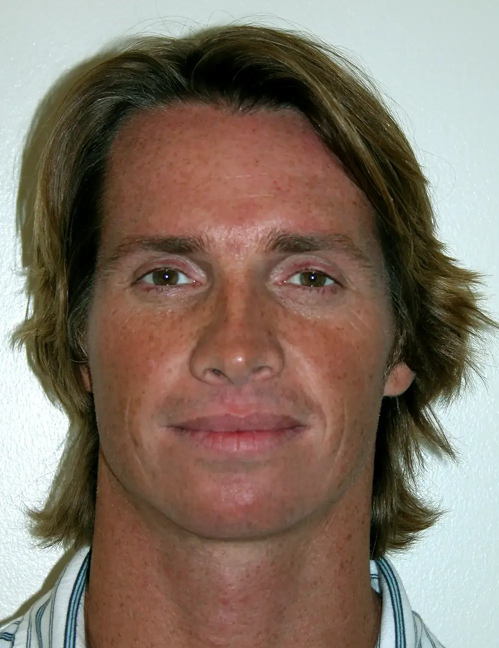 Male Rhinoplasty 6151 After Front View