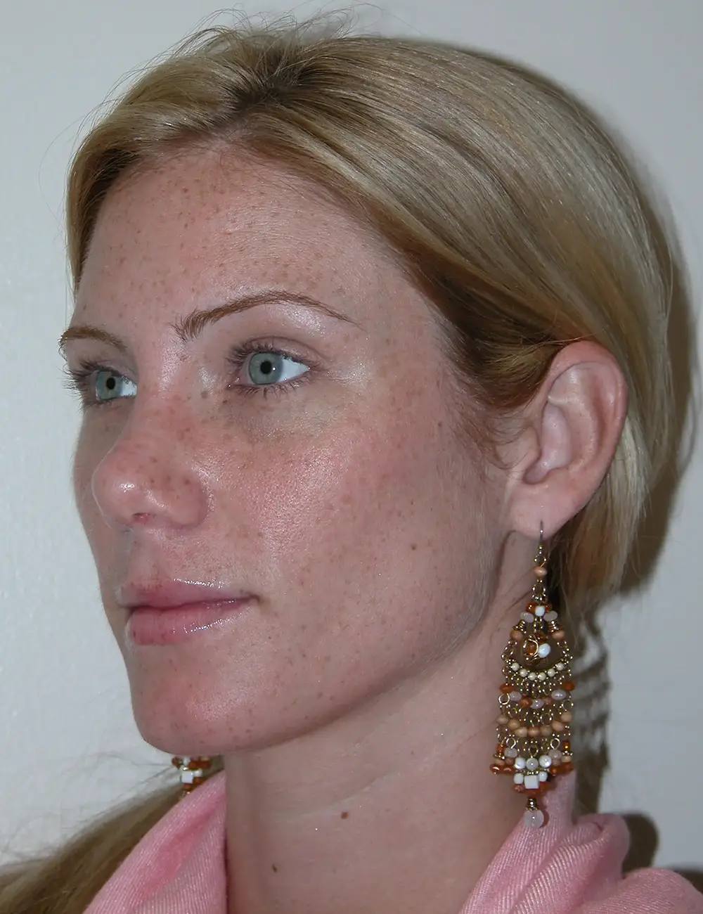 Rhinoplasty 8594 After Oblique View