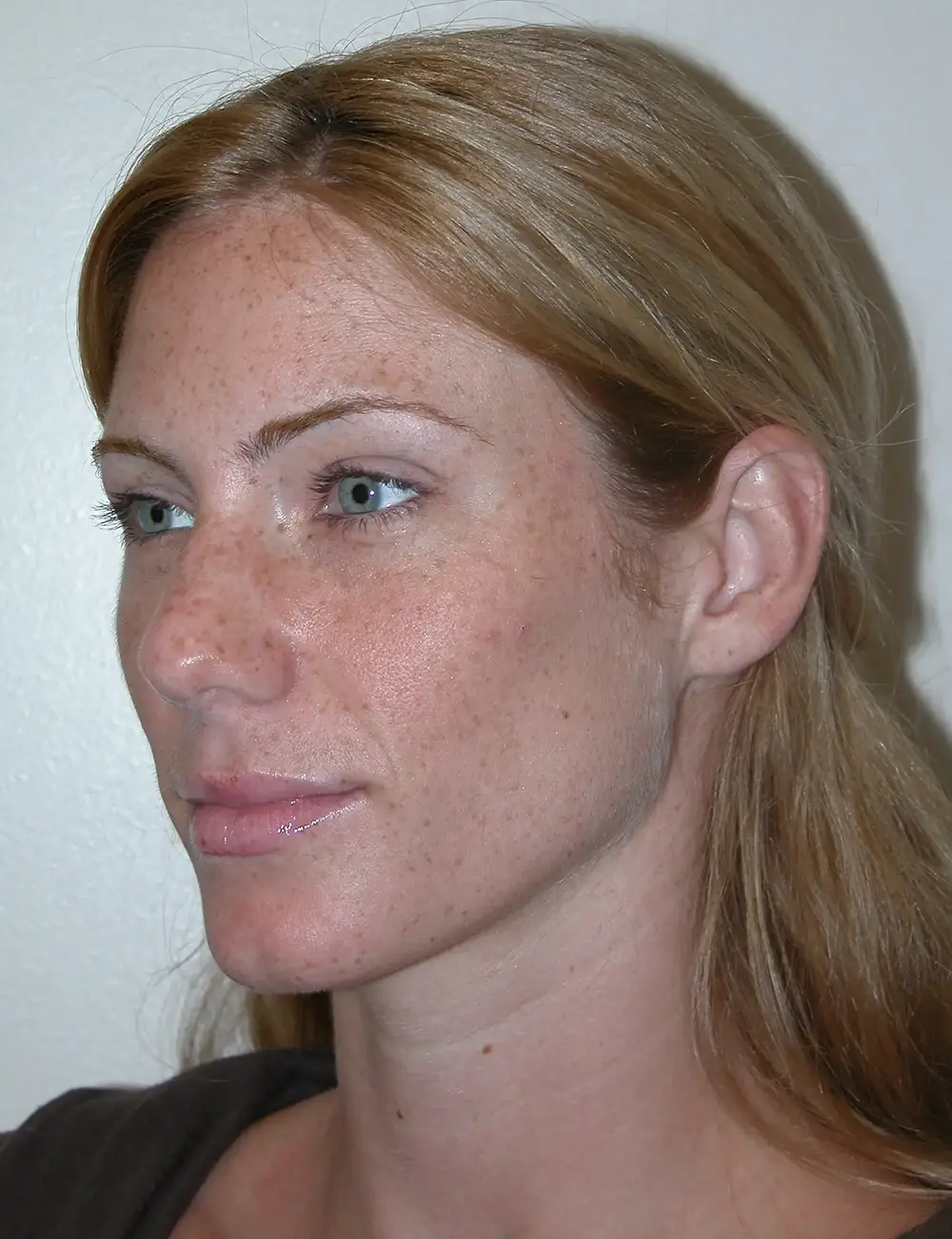 Rhinoplasty 8594 Before Oblique View