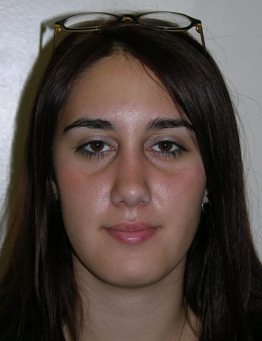 Rhinoplasty 1045 After Front View 