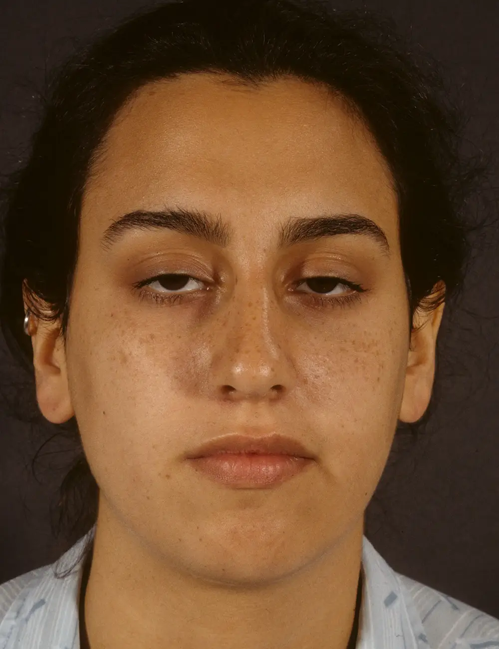 Rhinoplasty #2560 Before Front View