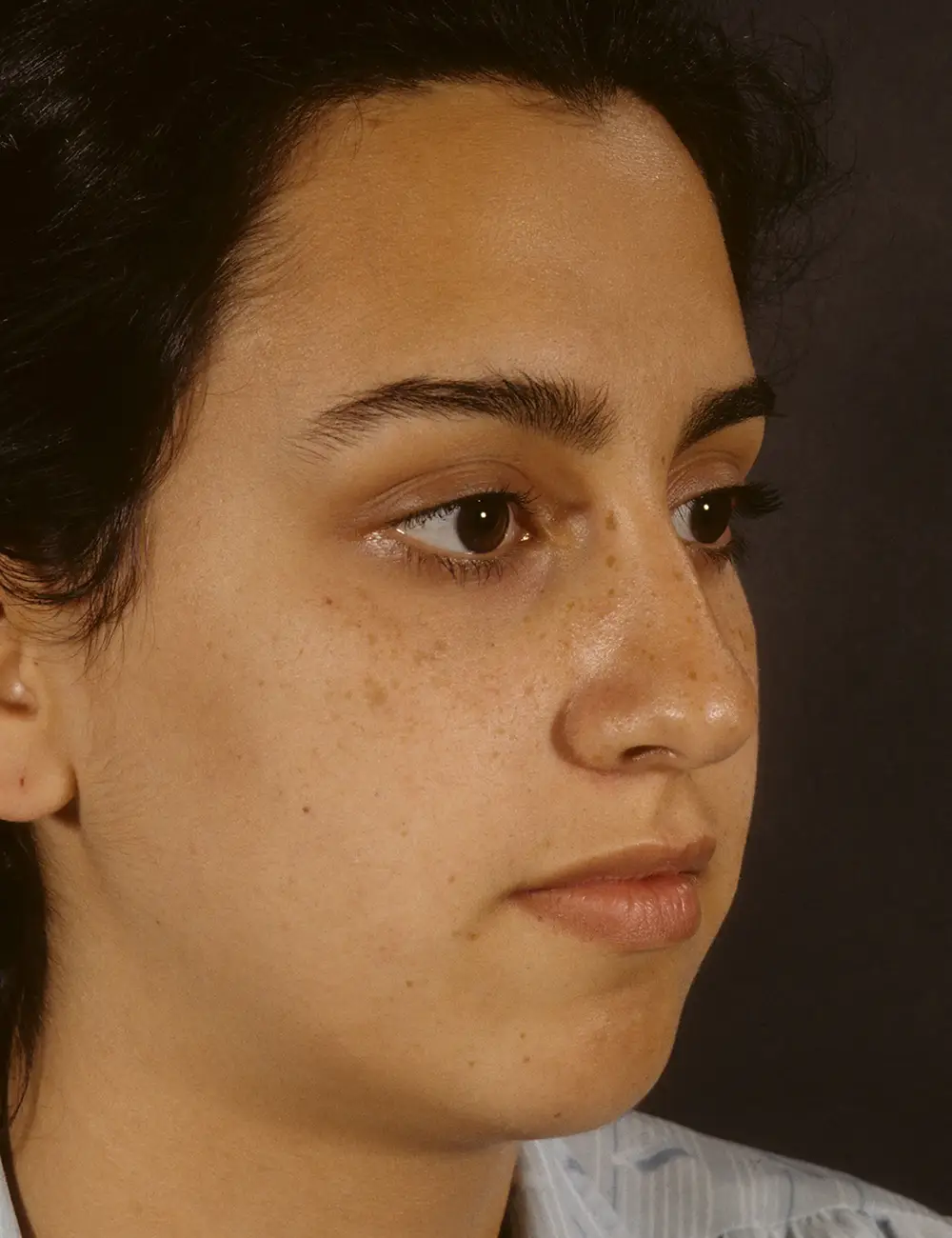 Rhinoplasty #2560 Before Oblique View