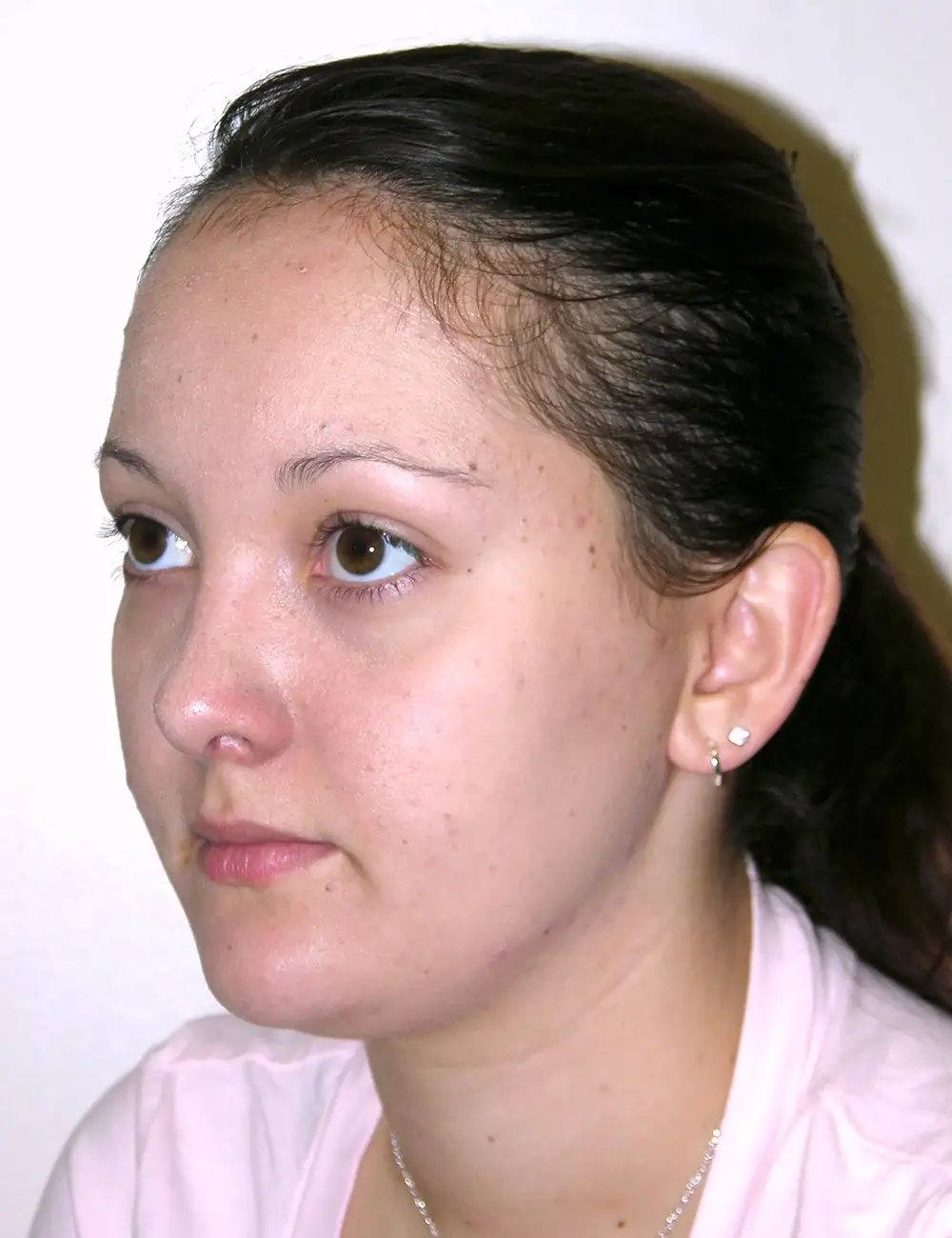 Rhinoplasty 5621 After Oblique View Left