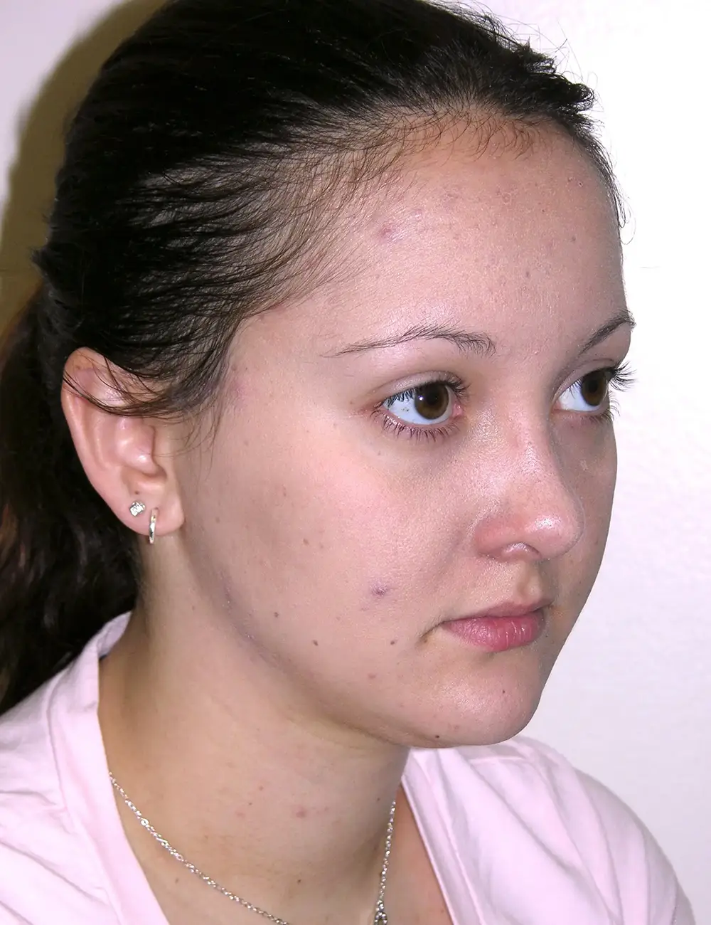Rhinoplasty 5621 After Oblique View