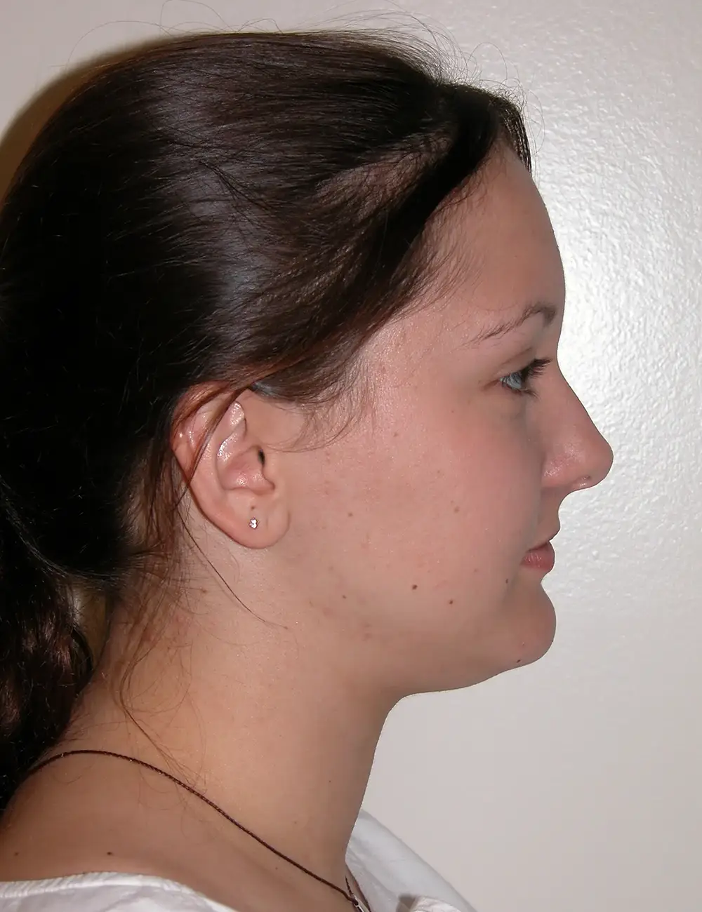 Rhinoplasty 5621 Before Profile View