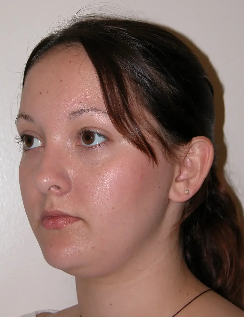 Rhinoplasty 5621 Before Oblique View Left