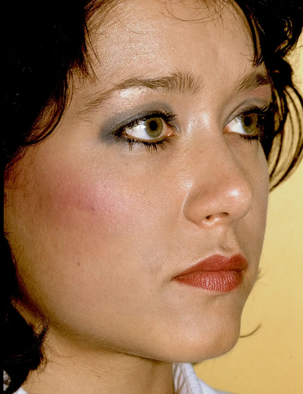 Rhinoplasty #9675 After Oblique View