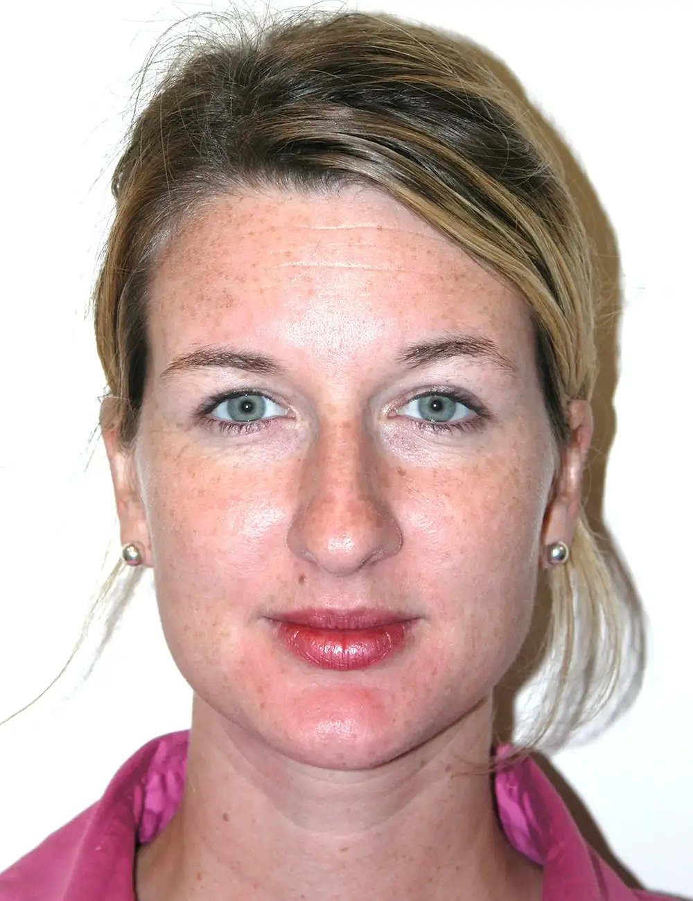 Rhinoplasty 5431 Before Front View 