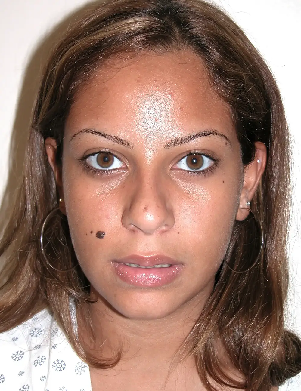 Ethnic Rhinoplasty #3399 Before Front View