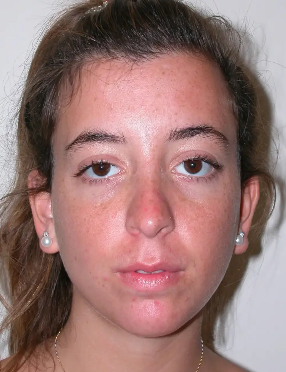 Ethnic Rhinoplasty #6472 After Front View