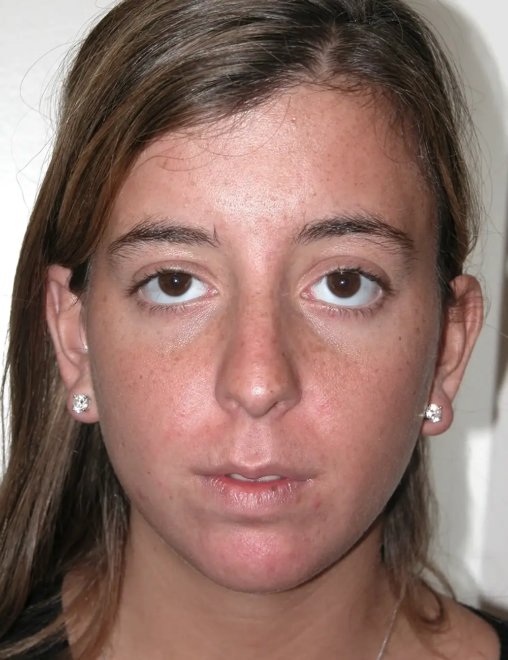 Ethnic Rhinoplasty #6472 Before Front View