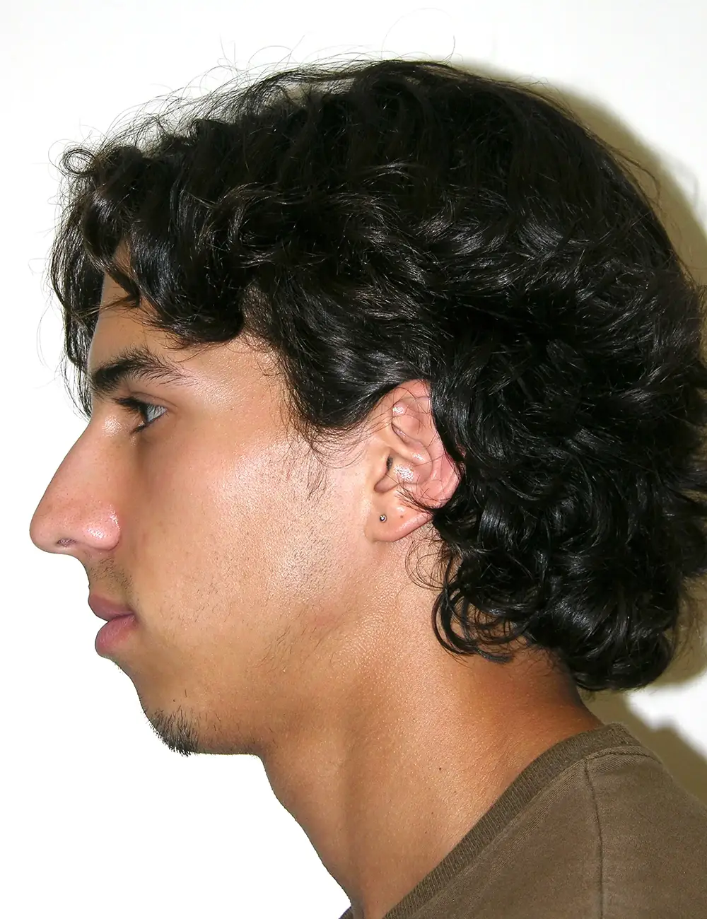 Male Rhinoplasty #9064 Before Profile View