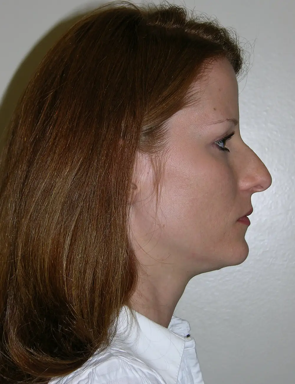 Rhinoplasty 1531 Before Profile View 