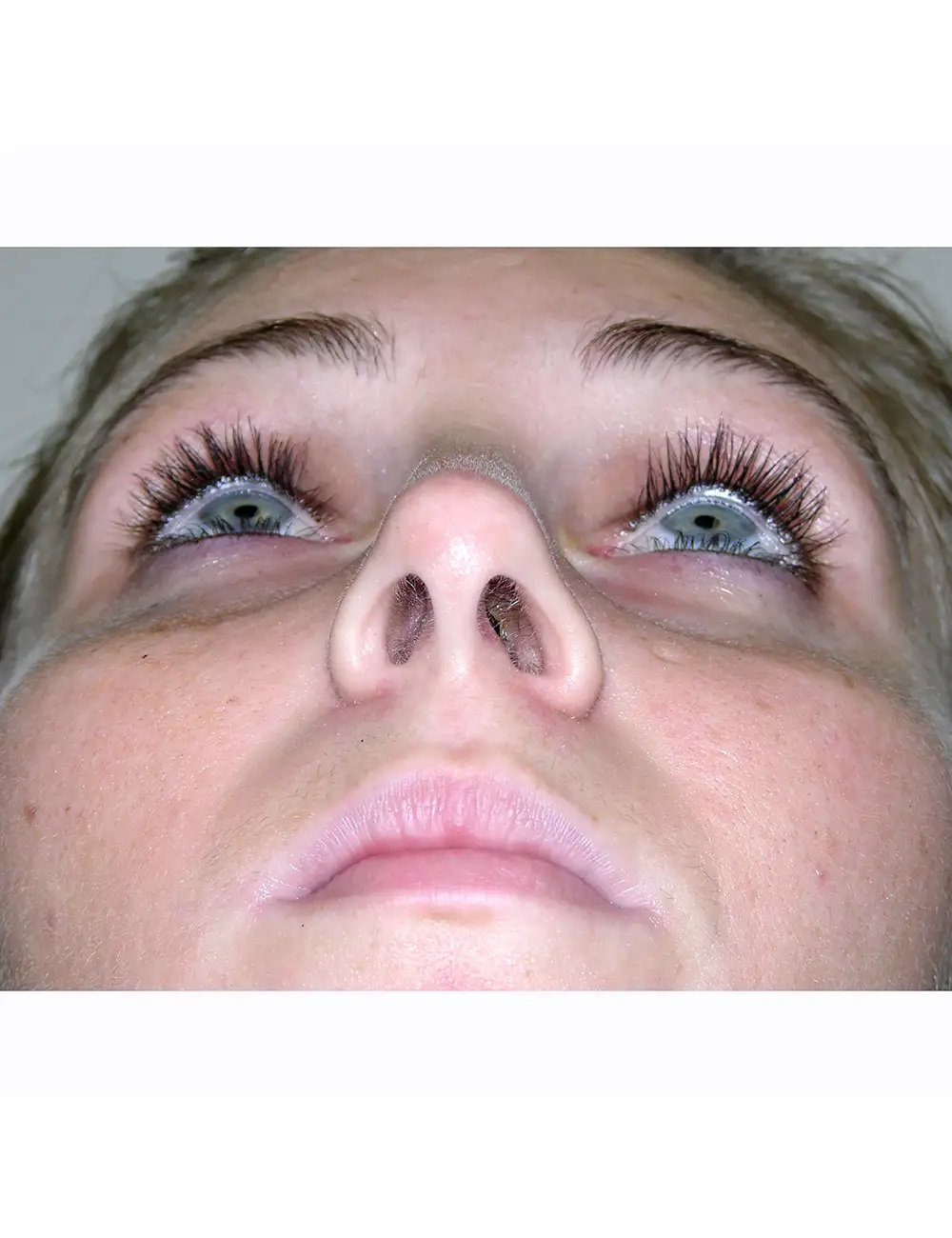 Rhinoplasty 9020 After Tip View