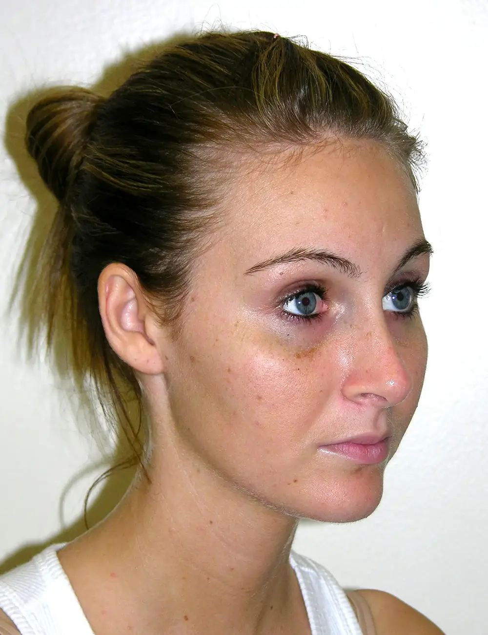 Rhinoplasty 9020 After Oblique View