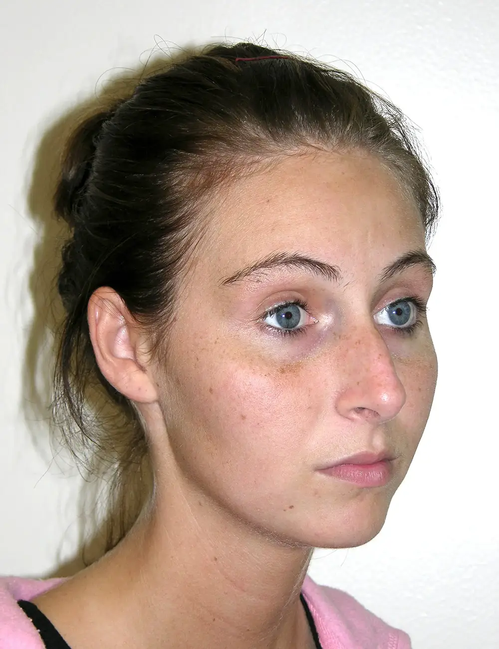 Rhinoplasty 9020 Before Oblique View