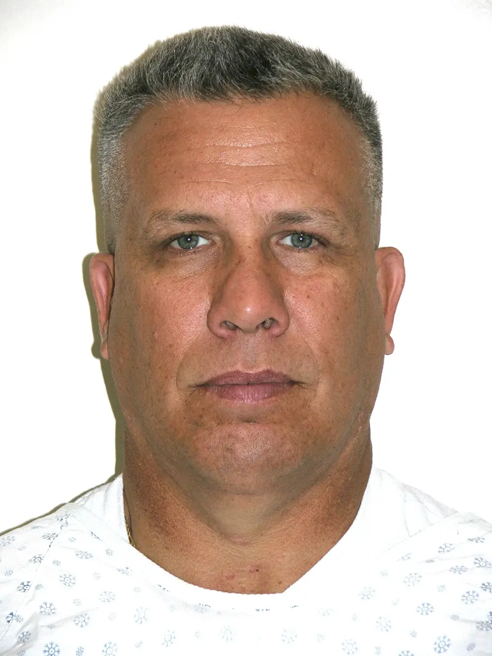 Otoplasty--1204 | Before Face