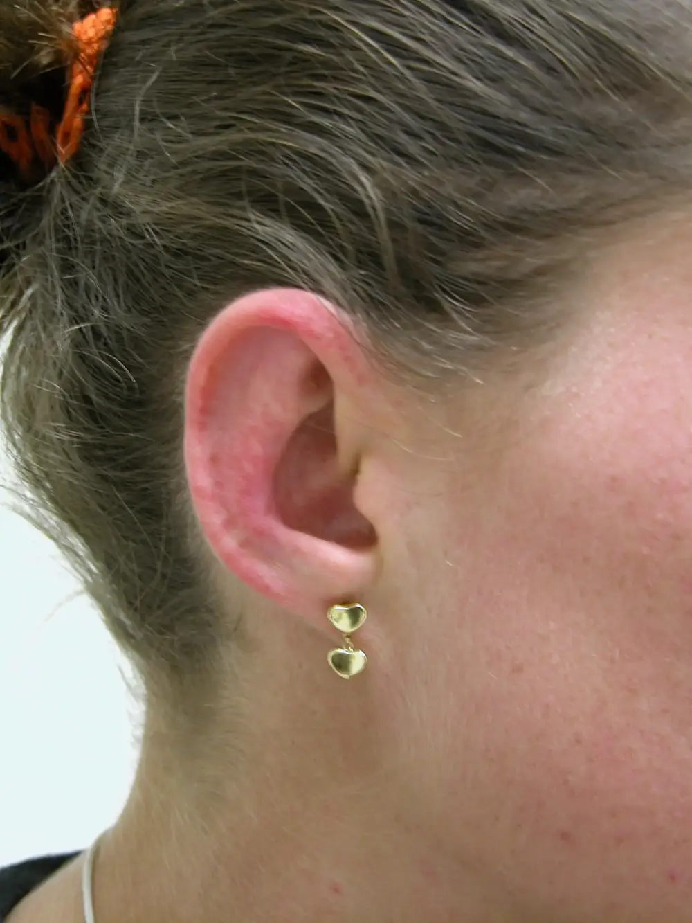 Otoplasty--7924 | After Otoplasty 3