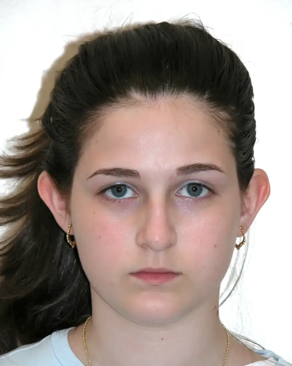 Otoplasty--8912 | Before Otoplasty 1