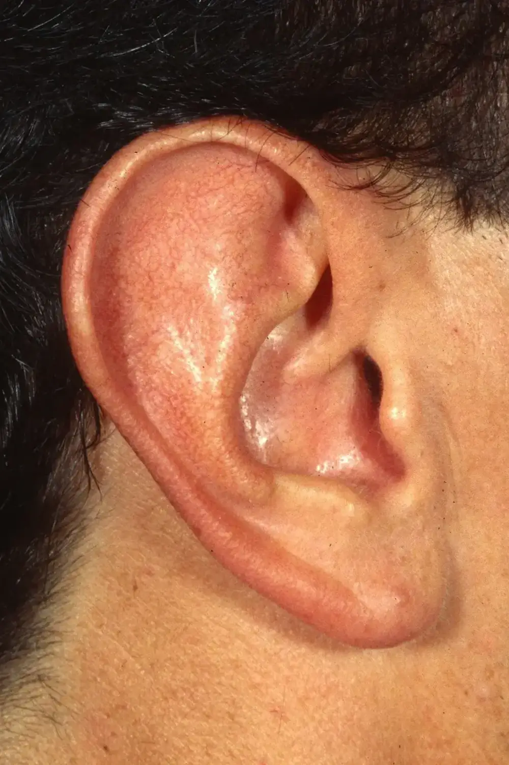 Otoplasty--1009 | After Otoplasty 3