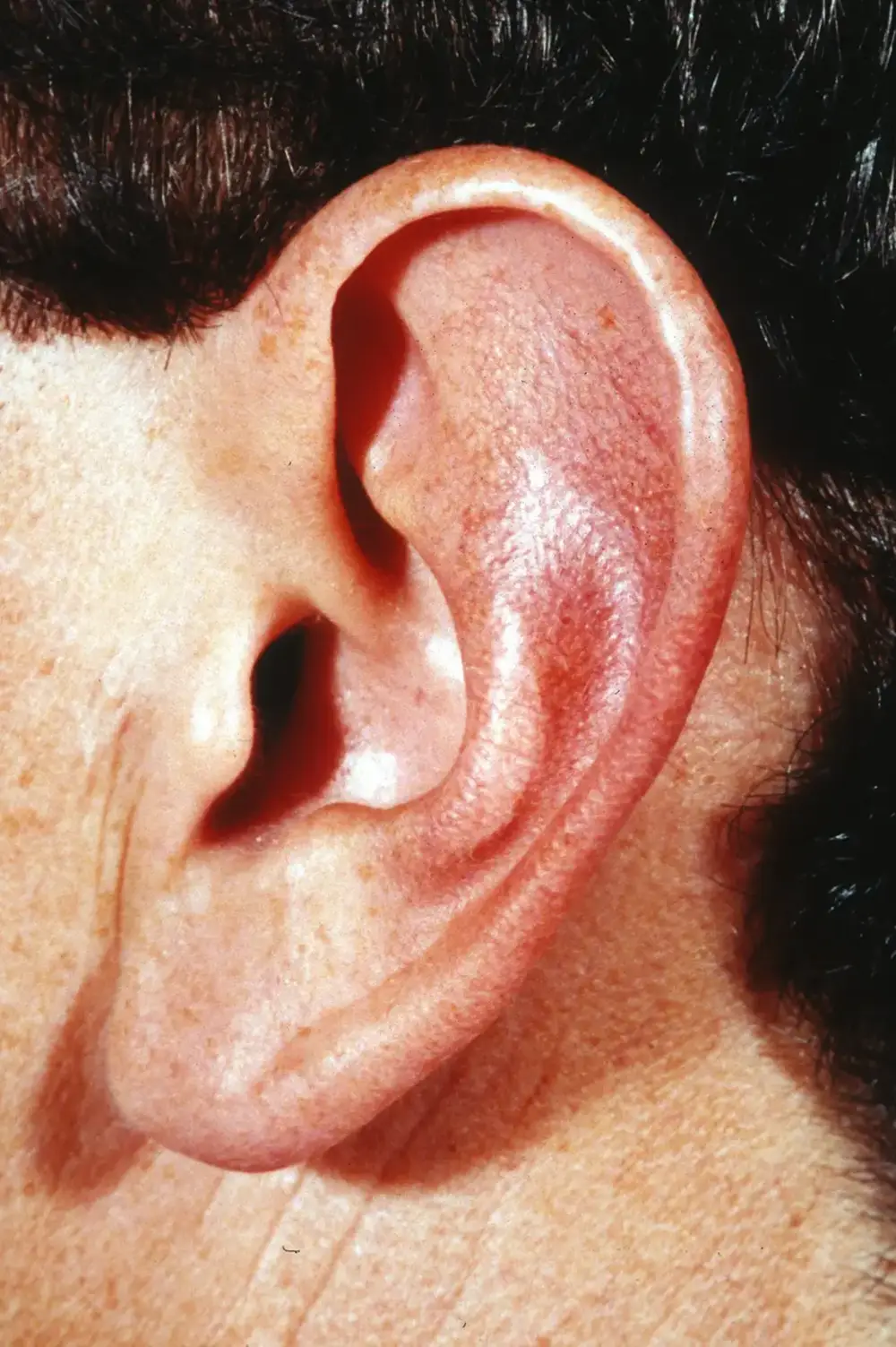 Otoplasty--1009 | Before Otoplasty 4