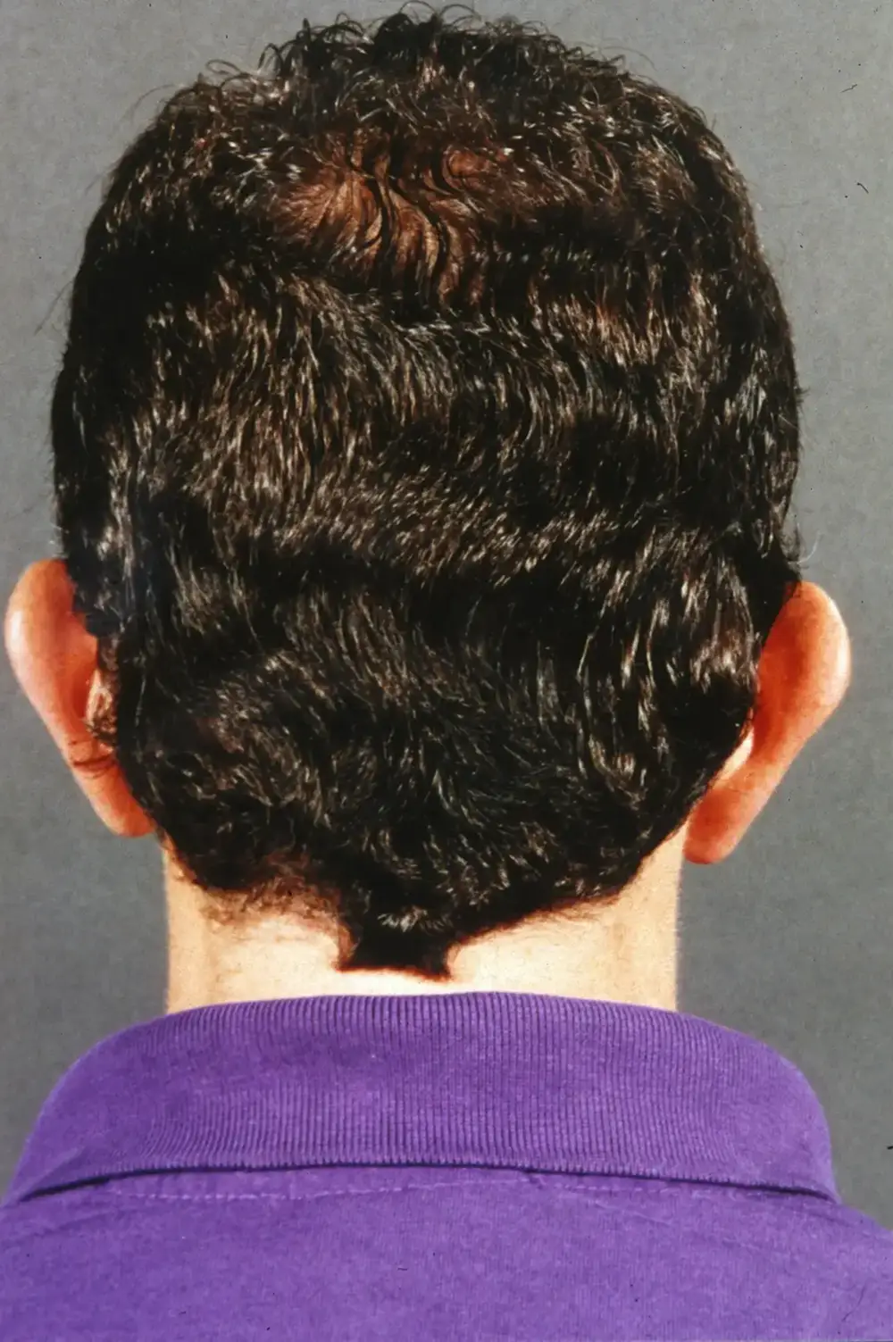 Otoplasty--1009 | Before Otoplasty 2