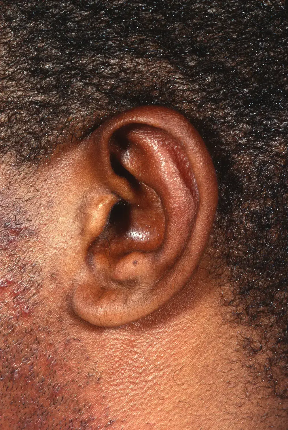 Otoplasty--7464 | After Otoplasty 4