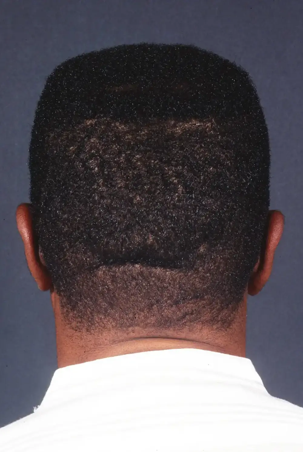 Otoplasty--7464 | After Otoplasty 2