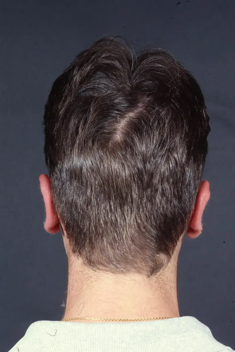Otoplasty--3986 | After Otoplasty 2