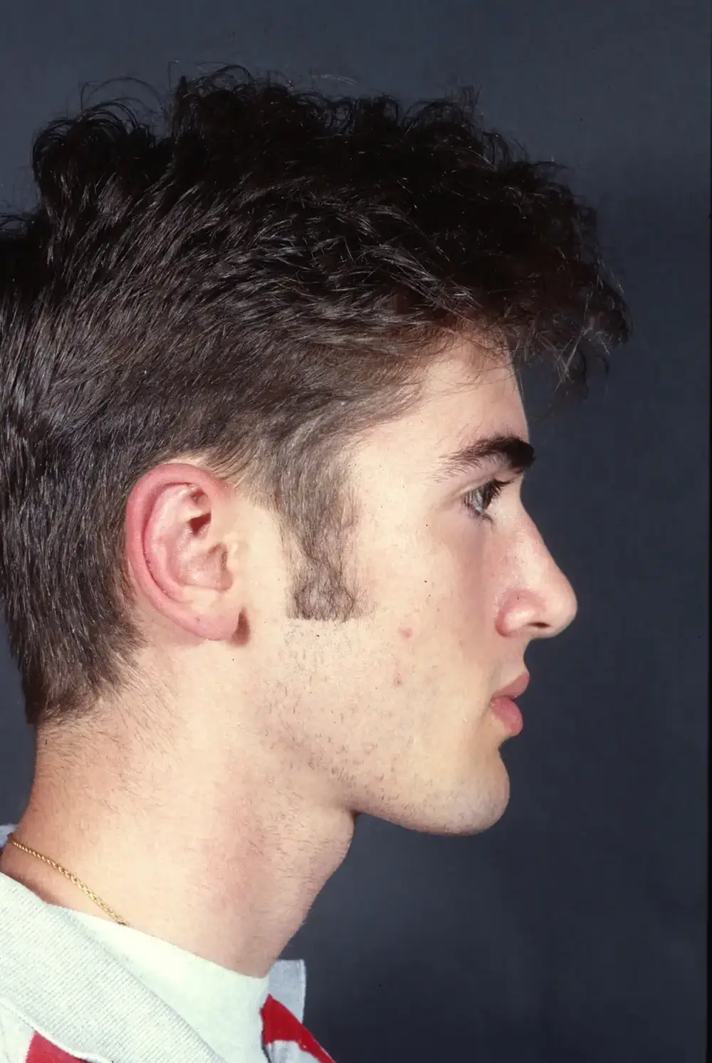 Otoplasty--3986 | After Otoplasty 4