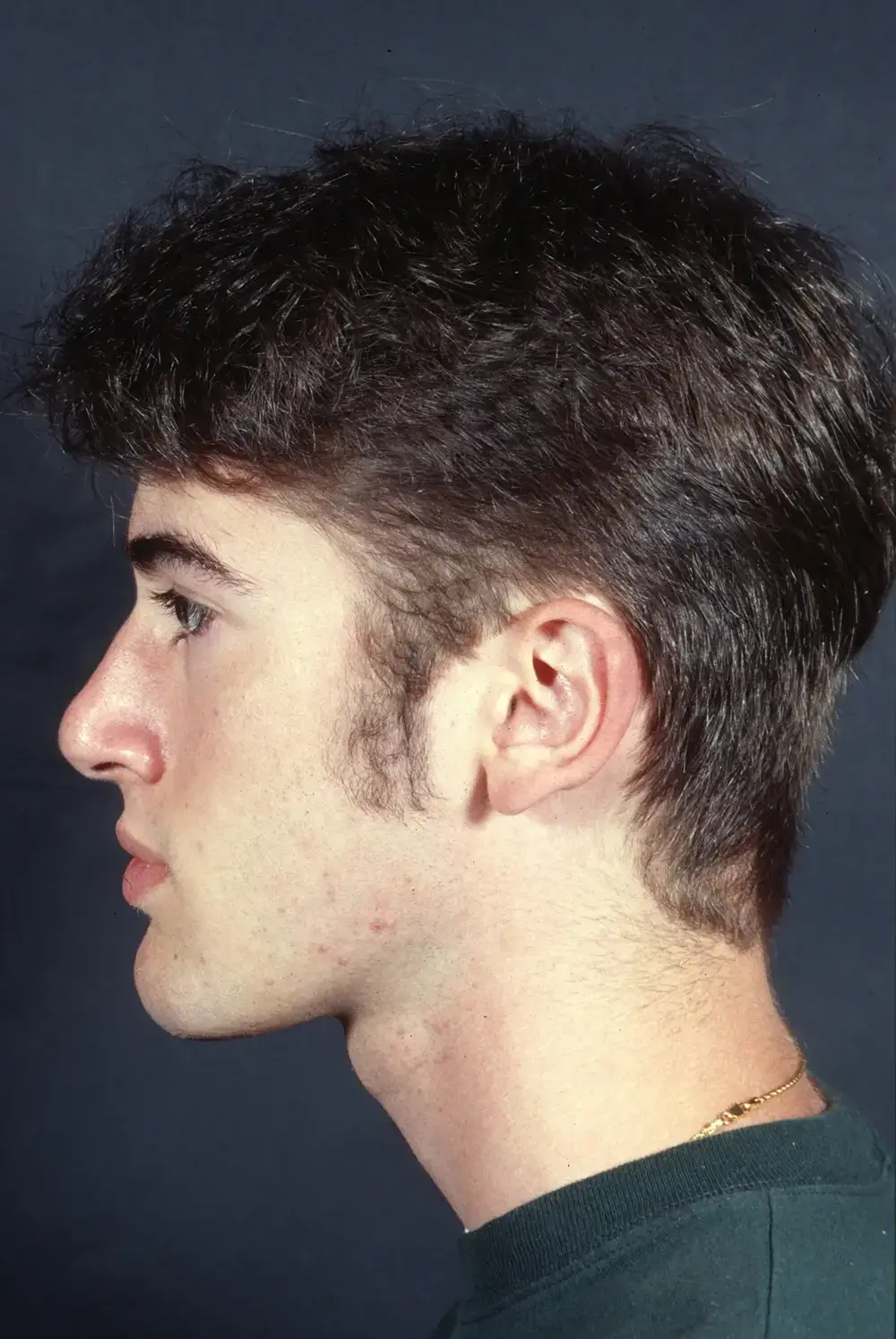 Otoplasty--3986 | Before Otoplasty 3