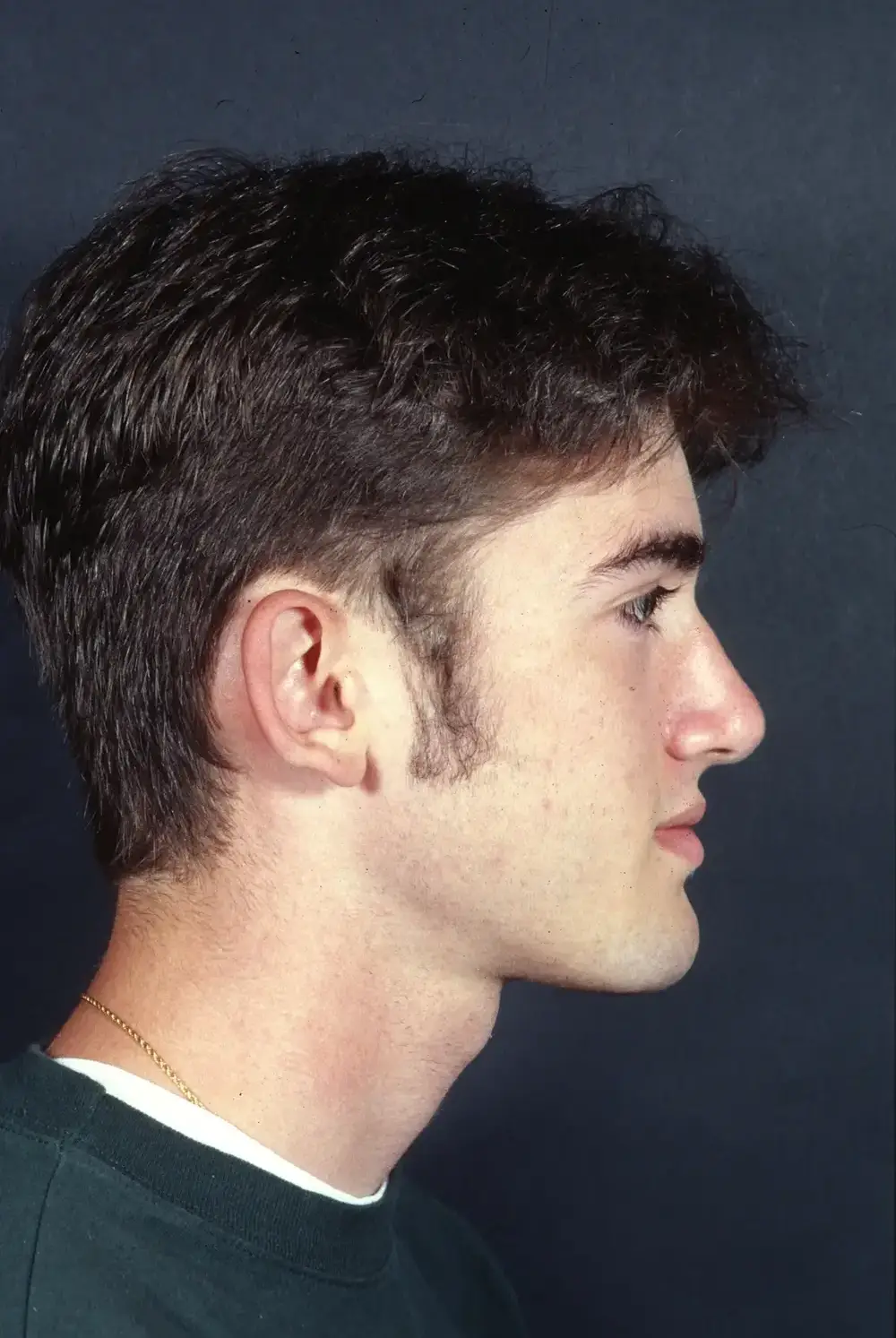 Otoplasty--3986 | Before Otoplasty 4