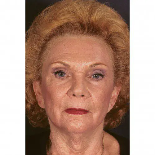 Case--8046 | After Peels & Fillers 1