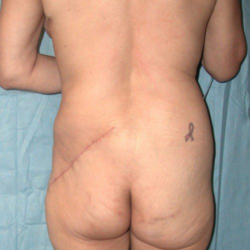 Breast-Reconstruction--9642 | After Breast Reconstruction 1