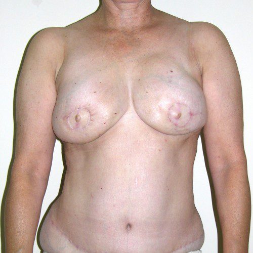 Breast-Reconstruction--5697 | After Breast Reconstruction