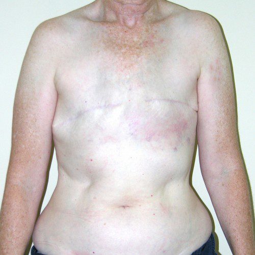Breast-Reconstruction--3598 | Before Breast Reconstruction
