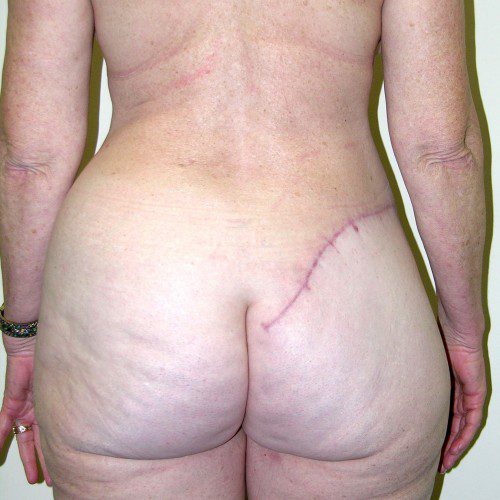 Breast-Reconstruction--3891 | After Breast Reconstruction