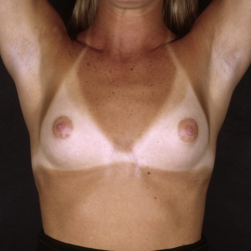 Breast-Augmentation--7787 | Before Breast Augmentation 4