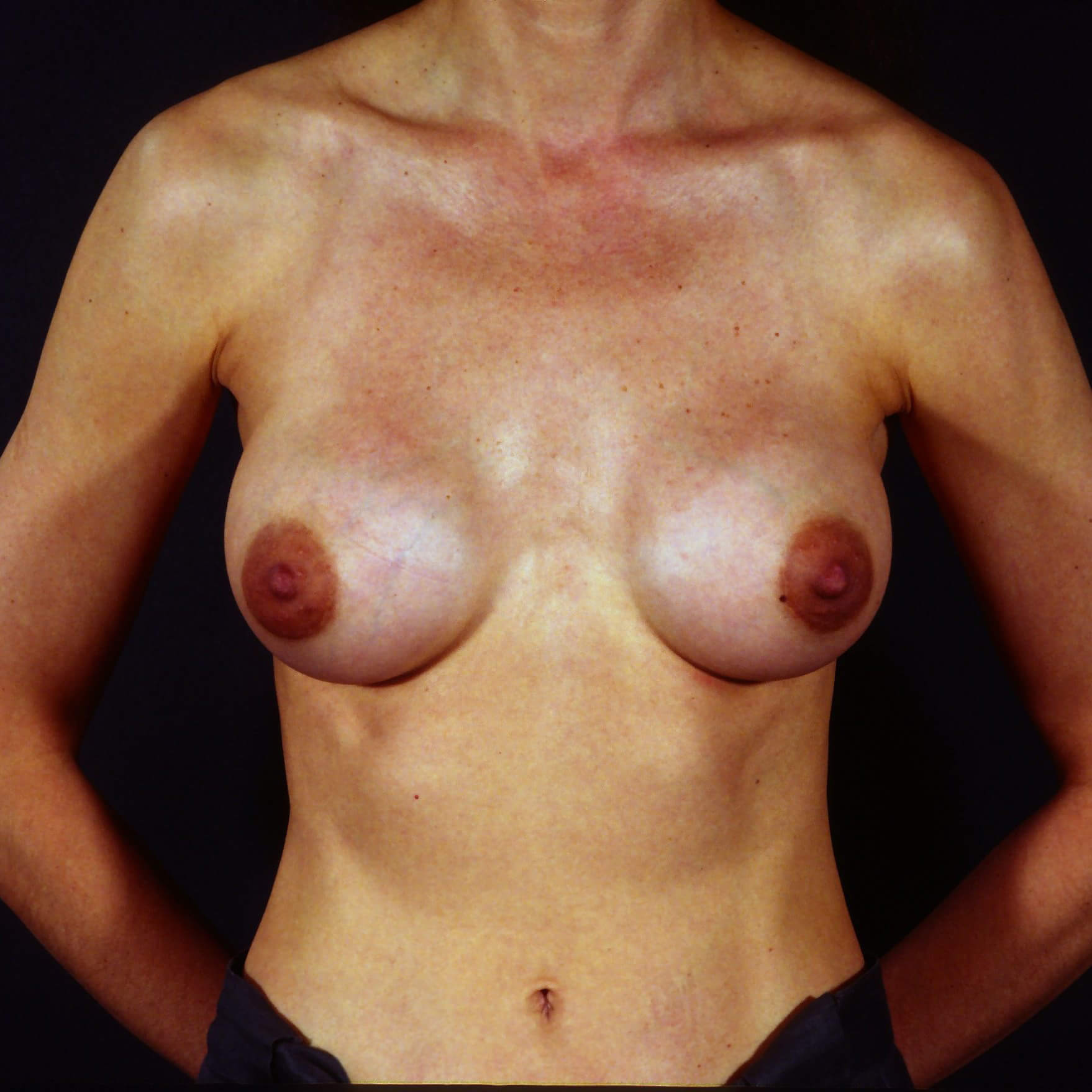 Breast-Revision--7317 | Before Breast Revision 1