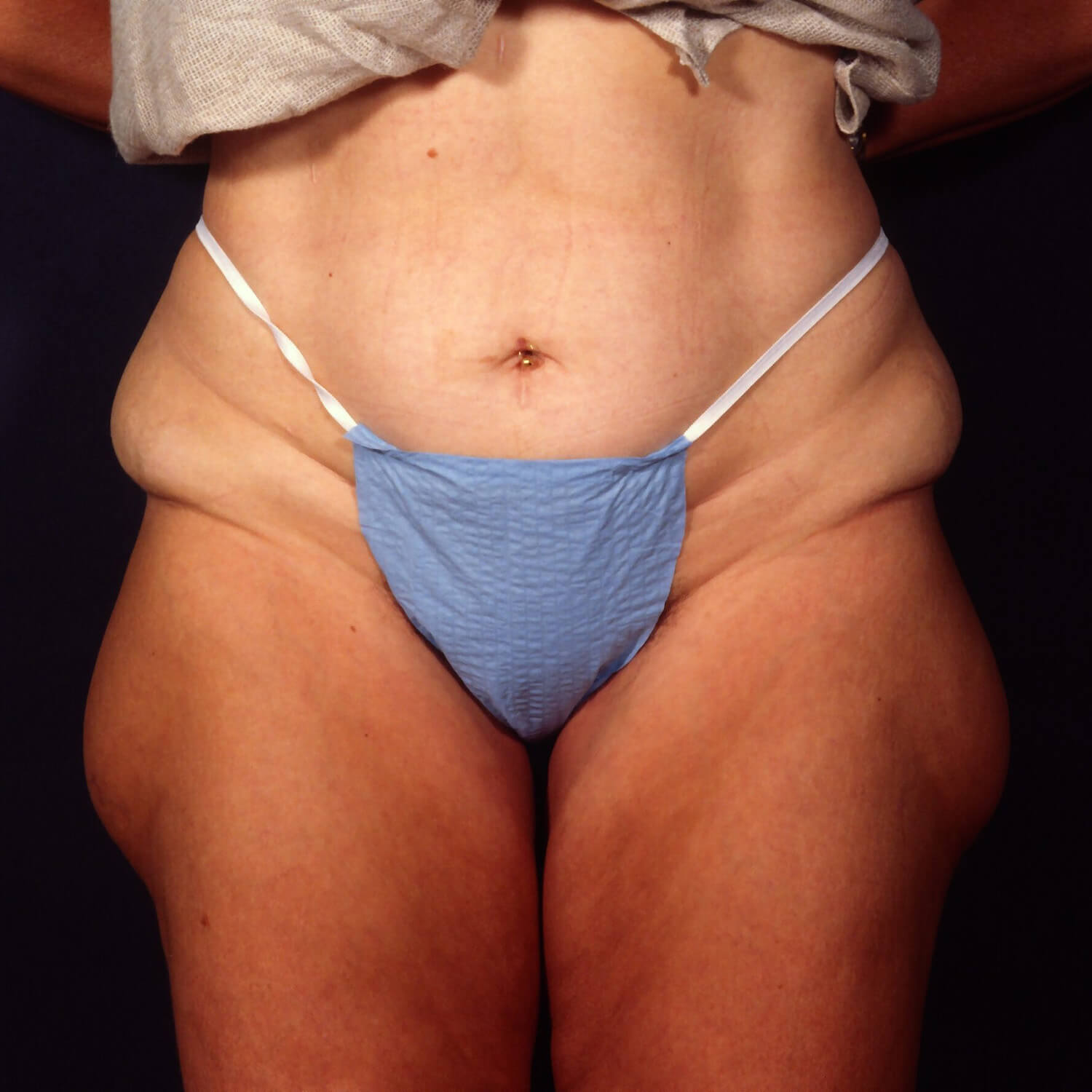 Liposuction--5359 | Before Body
